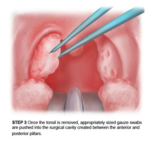 Tonsillectomy steps