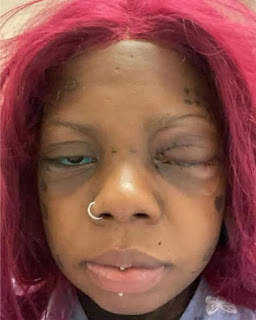 Mother On The Brink of  Going Blind After Obtaining Eyes Tattoos[image]