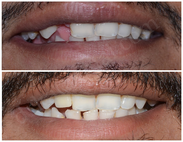 Before After photos of fractured right lateral incisor treated with dental implant