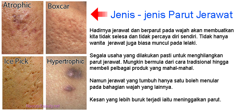  Cara  Menghilangkan  Jeragat Cara  Hilangkan Parut Jerawat 