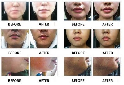 face slimming mask before and after 7 day