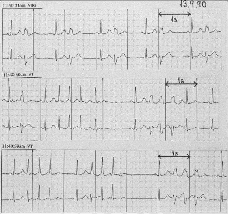 RSR паттерн на ЭКГ. RSR паттерн в 1 отведении. Parasymal Supraventricular. Блокированные экстрасистолы