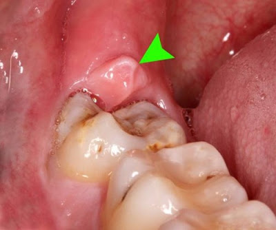 Hỏi bác sĩ viêm lợi trùm có nguy hiểm không 1