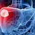Obat manjur alami pembengkakan Hati karna liver thumbnail