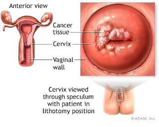 Recognize what is Cervical Cancer
