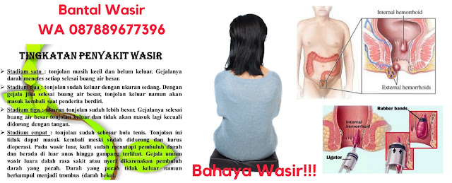 Dokter Oz Wasir, Cara Mengobati Wasir, Cara Menyembuhkan Wasir