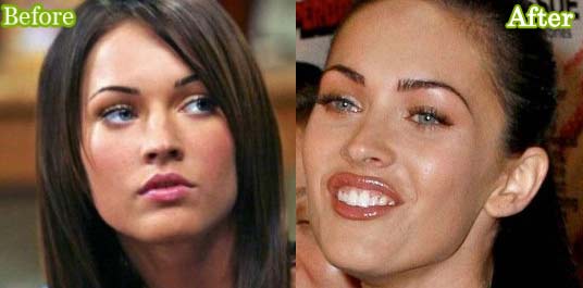 Megan Fox Plastic Surgery Before After