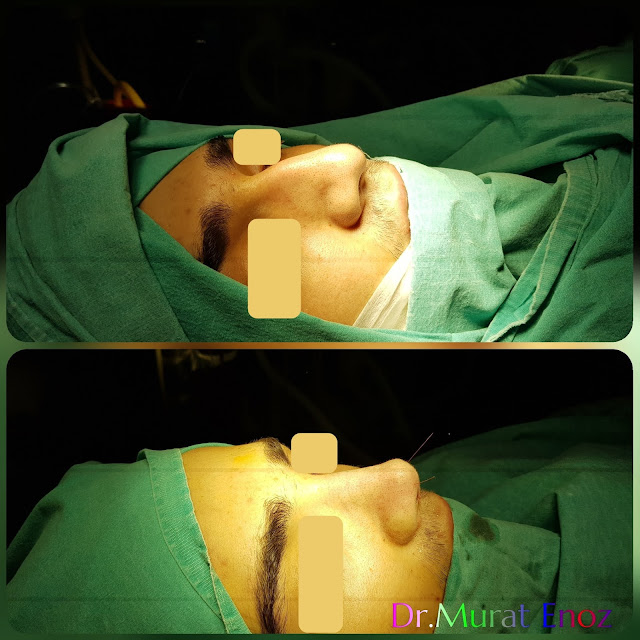 Male rhinoplasty- Nose job for men Istanbul Turkey