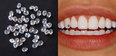 đính kim cương vào răng