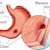  Know the best ways to treat Stomach Ulcers
