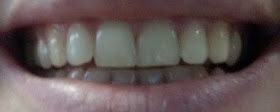 blanqueamiento dental iWhite