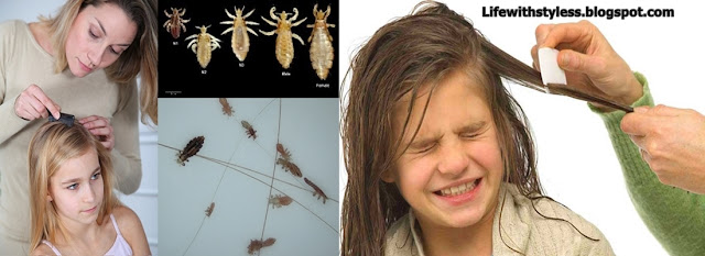 Get Rid Of Head Lice in 3 Simple Steps