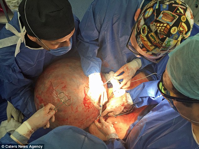 24-Year-Old Woman Has the World's Biggest Cyst Removed After Her Organs Were Crushed