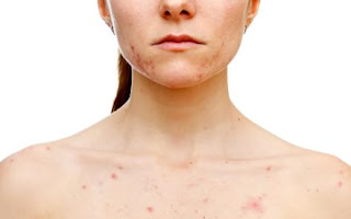  What then causes acne?