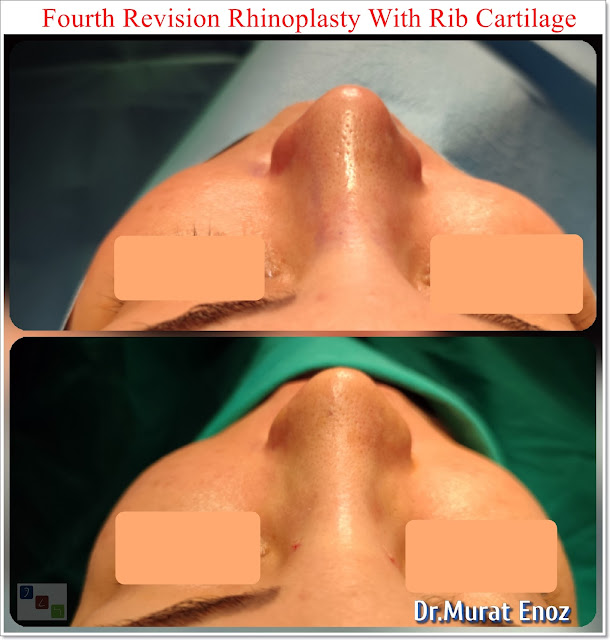 Fourth revision rhinoplasty, 4. revision nose job,