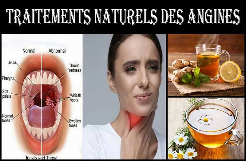 Traitements naturels des angines