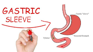 Experiences of those who have done gastric sleeve