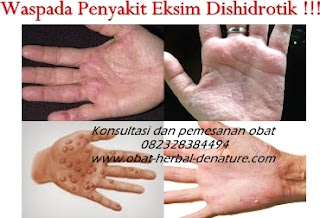 cara mengobati gatal,obat gatal atau eksim,obat eksim,cara menghilangkan gatal pada tangan,cara menghilangkan gatalk pada kaki