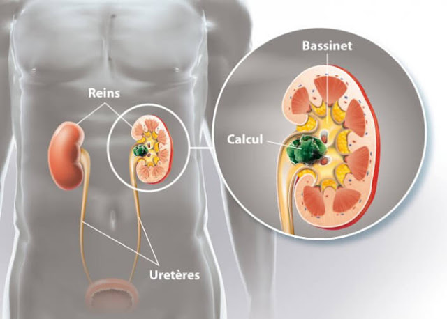 Lithiase urinaire, Calculs urinaires, Diagnostic, Causes et traitement