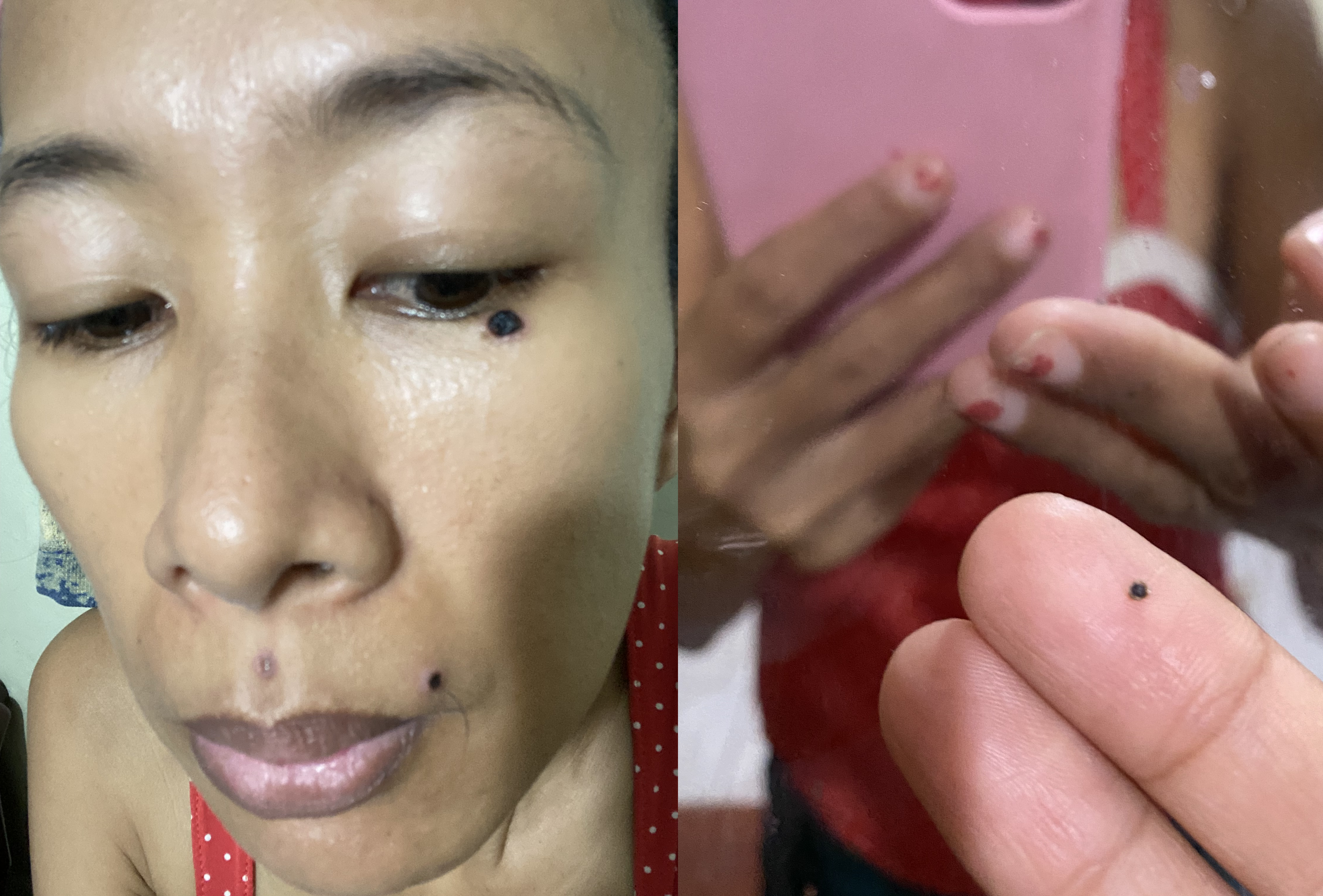 where to remove moles in manila