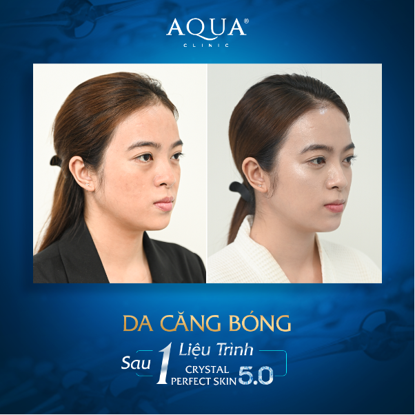 Aqua Clinic ra mắt công nghệ căng bóng da hiện đại bậc nhất <a href=
