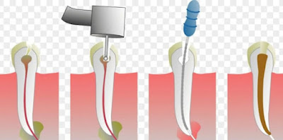 Tin nha khoa: Trám răng lấy tủy giá bao nhiêu?-1