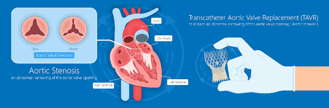 TAVR expert in India
