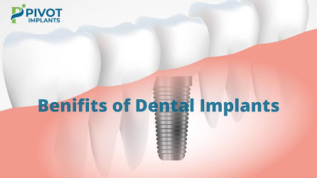Best Titanium Dental Implants In India 2021