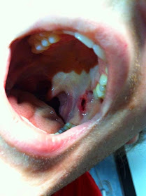 oral trauma toothbrush puncture would soft palate