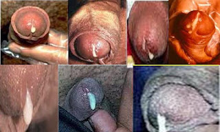 Obat Keluar Cairan Putih Dari Ujung Penis