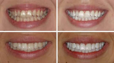 How To Transform Your Teeth From Yellow To White