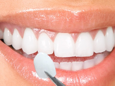 Bọc răng sứ là gì?