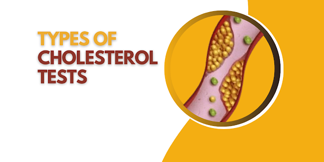 Screening Options and Types of Cholesterol Tests