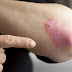 الصدفية Psoriasis.. مرض أم ابتلاء