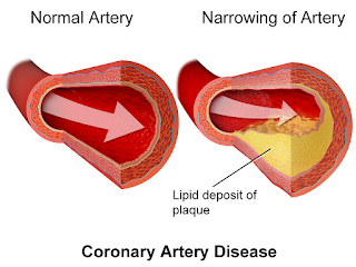 Coronary Artery Disease / Penyakit arteri koroner / jantung koroner