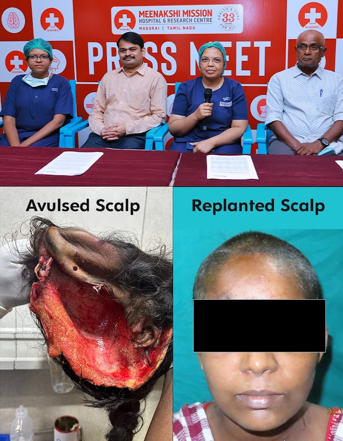 Emergency Plastic Surgery at Madurai Meenakshi Mission Hospital Replants Scalp Ripped Off in a Freak Accident