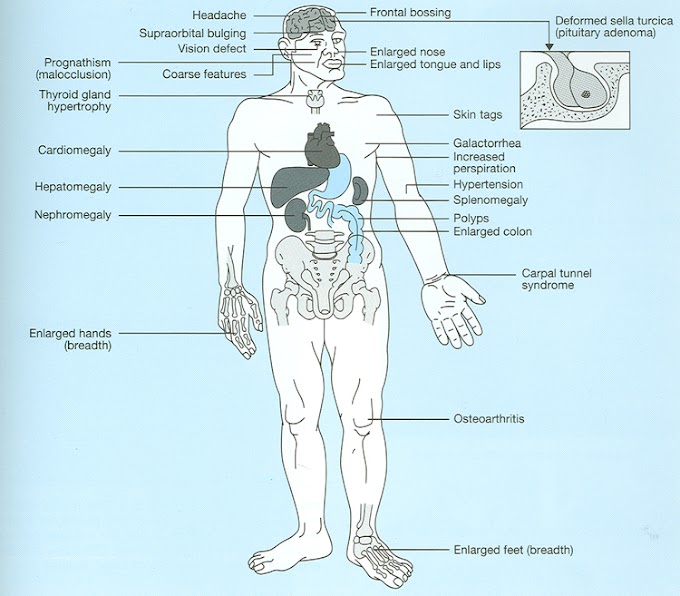 Acromegaly:Definition,Causes,Symptoms,Diagnosis,Treatment