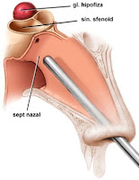 abord transsfenoidal