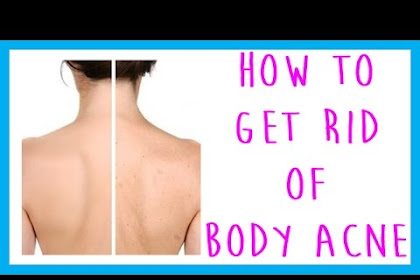 Easy Ways To Treat Body Acne  