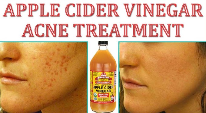 Benefits of Using Apple Cider Vinegar For Acne