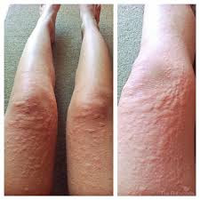  Cara mengobati alergi pada kulit http://www.hidup-sehat.org/