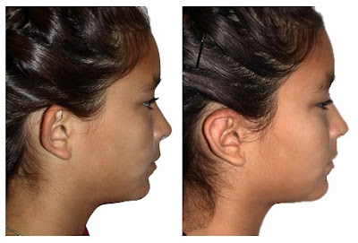 Otoplasty Before After