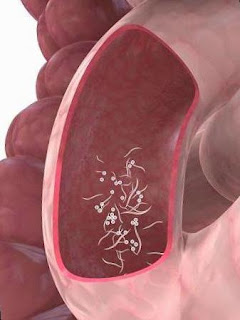 Oxiuros: Causas, Síntomas y Tratamiento