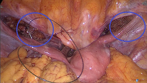 ▲腹腔鏡手術放置人工網膜之術中照片。（大里仁愛醫院提供）
