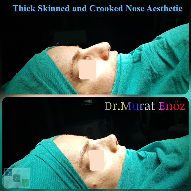 Crooked Nose Aesthetic,Female Nose Job, Rhinoplasty in Istanbul