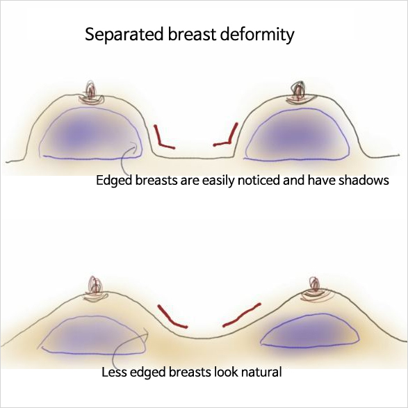 Dr. Lee Breast augmentation Korea: Composite breast augmentation