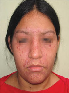 Lupus miliar diseminado facial