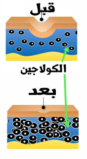 الديرمارولر للكولاجين