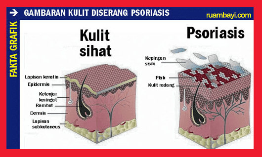 Psoriasis, Ruam Bayi Dan Semua Jenis Penyakit Kulit Sembuh Dengan Ruam Bayi Powder  Resipi Biskut