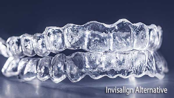 Invisalign Alternative